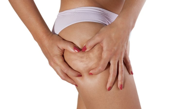 What is Cellulite, and Why Do I Have It?